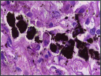 Lung tissue showing collections of alveolar macrophages with phagocytosed blackish pigment, carbon, without evoking an inflammatory response in the surrounding tissue. H&E stain 100X.