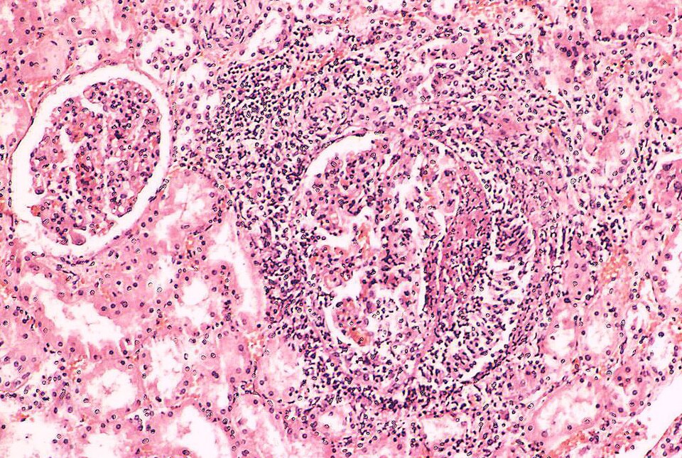 Kidney - Miliary tuberculosis