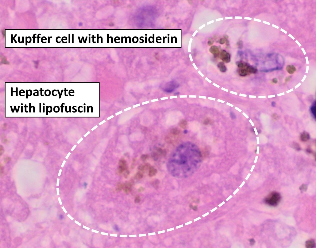 Kupffer cell with hemosiderin and hepatocyte with lipofuscin, H&E stain