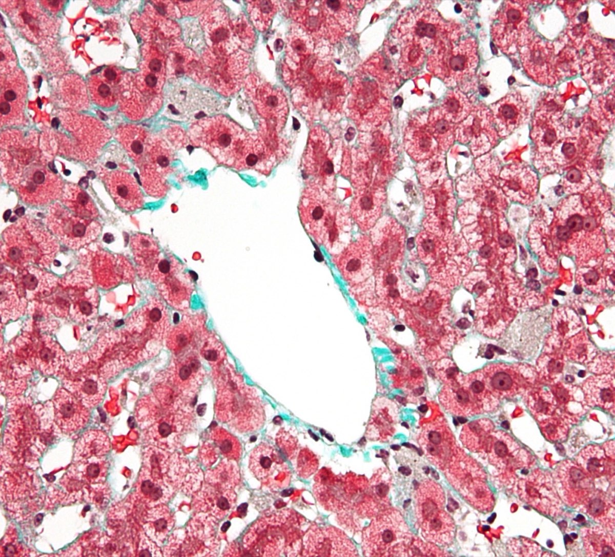 High magnification micrograph showing Kupffer cells, in the setting of a resolving congestive hepatopathy. Liver biopsy. Trichrome stain.
