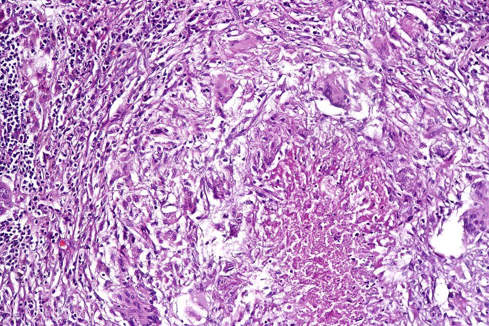 Pulmonary tuberculosis characterized by granulomatous inflammation with necrotizing epithelioid granulomas. H&E stain.